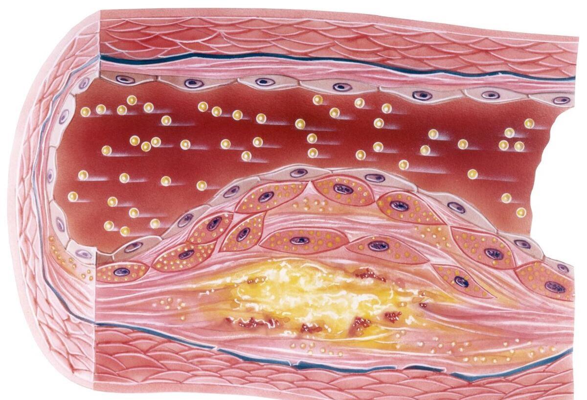 前沿醫(yī)療科技助力動(dòng)脈斑塊治療新突破