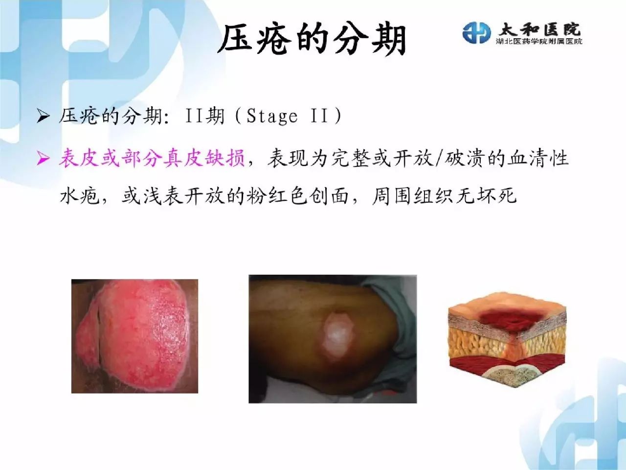 最新壓瘡定義，深化理解與提升護理策略